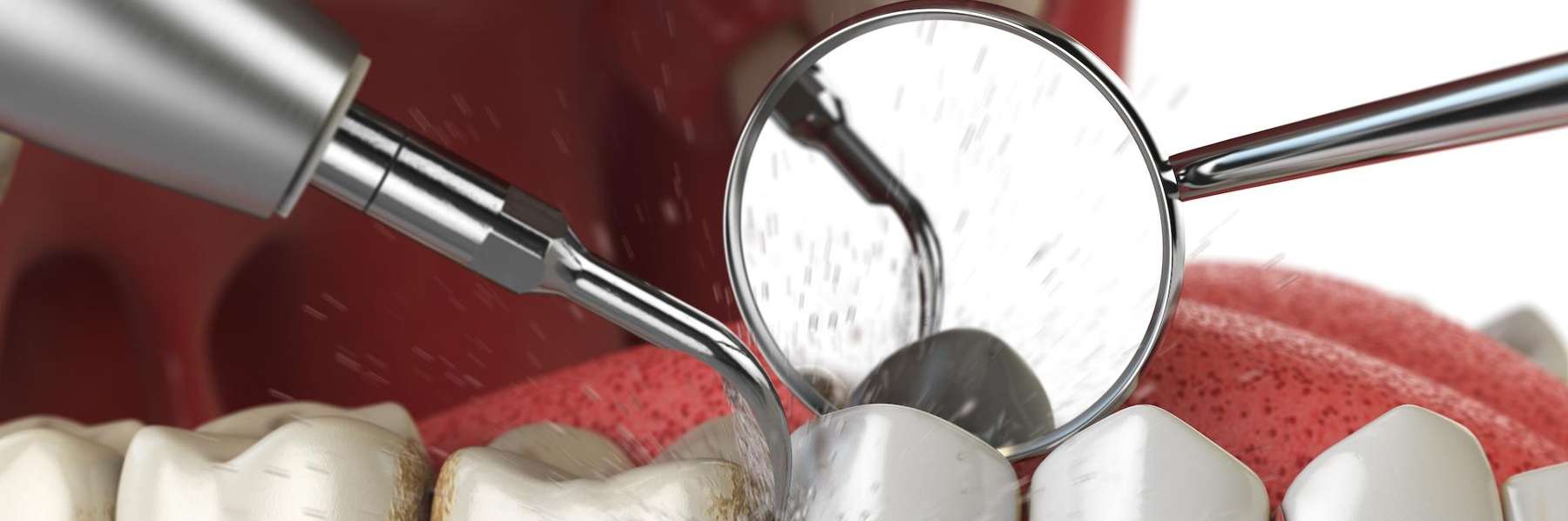 image of a teeth cleaning in brandon fl