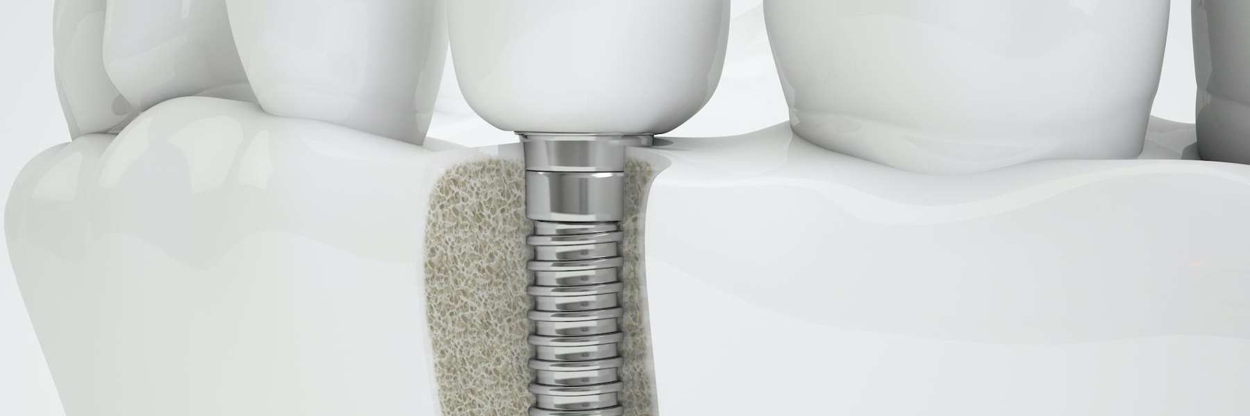 An illustration of a dental implant in Brandon, FL