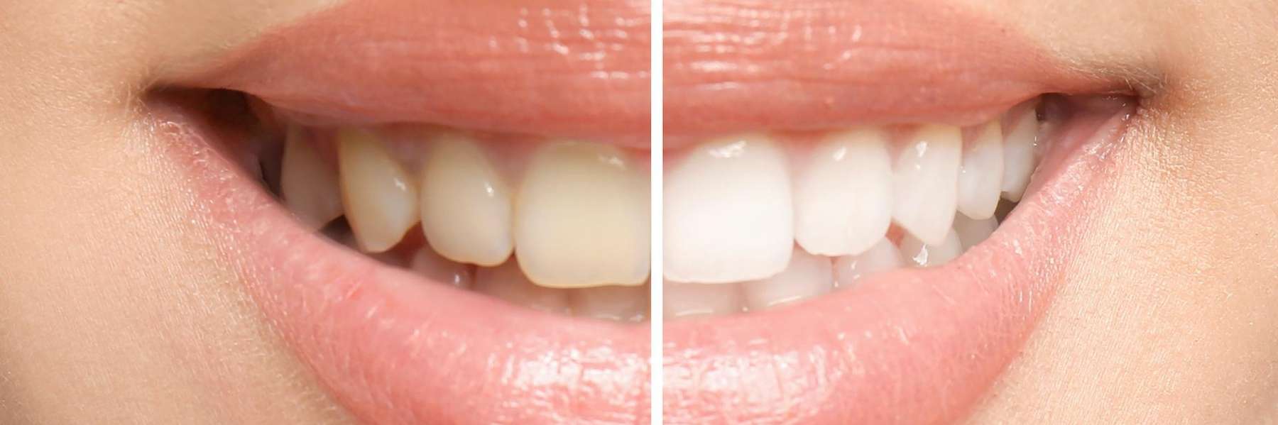 Close-up smile showing before and after teeth whitening results with brighter white teeth.