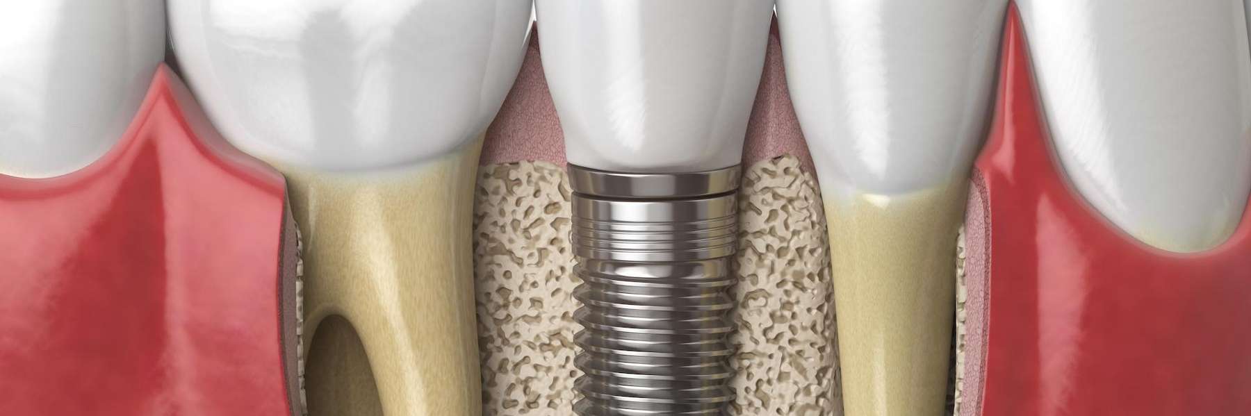 image of a dental implant in brandon fl