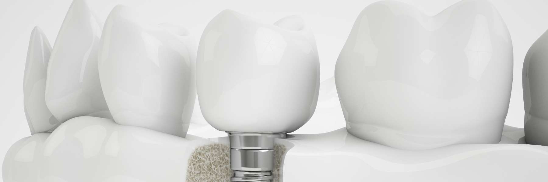 crown on dental implant