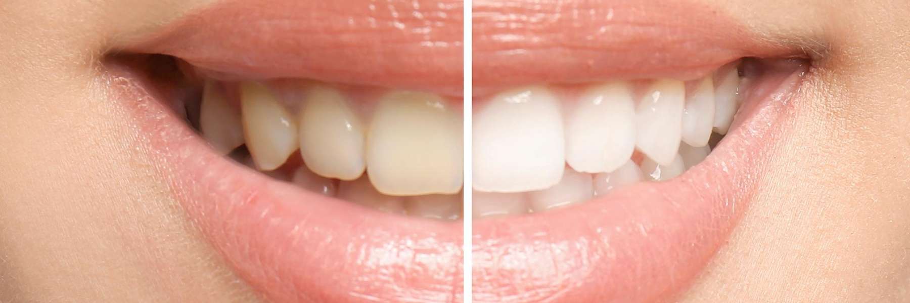 teeth whitening results in brandon fl