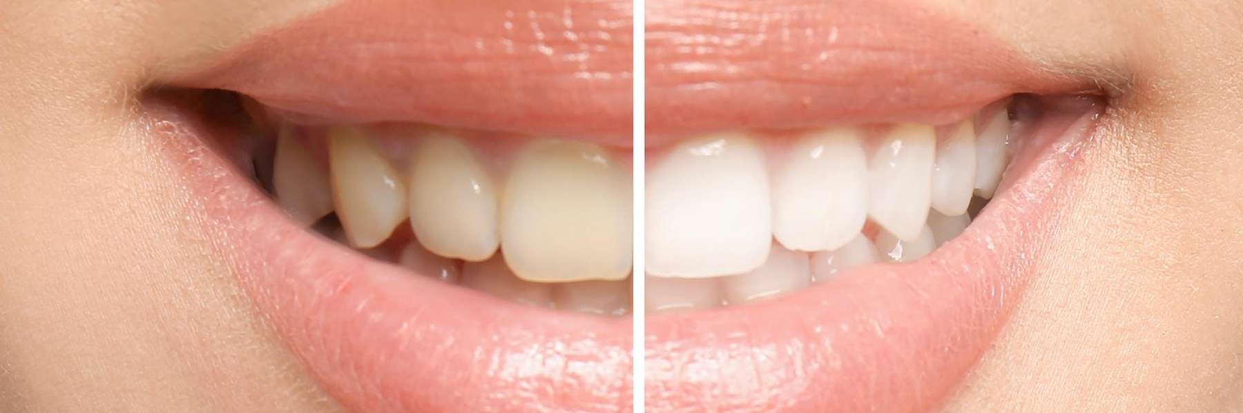 before and after picture of teeth whitening in brandon 