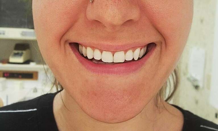 Results from lip flip at BOTOX dentist in Brandon, FL