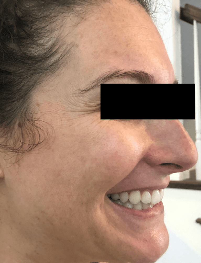 Dental patient with crows feet at BOTOX dentist in Brandon, FL