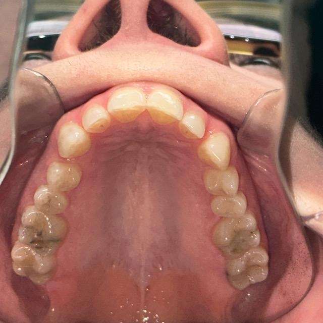 Invisalign-Before-Image