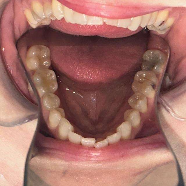 A patient's full mouth before receiving Invisalign